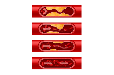 Atherosclerosis artery. Step-by-step cholesterol deposition arterial w