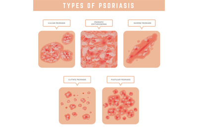 Psoriasis types. Skin problems close up medical illustrations vector s