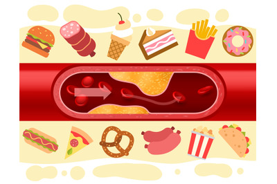 Consequences of fast food. Blood vessel with cholesterol plaque. Harmf