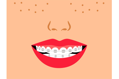 Smile with dental braces