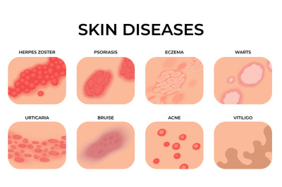 Skin disease. Different diseases&2C; epidermis surface with eczema. Derma