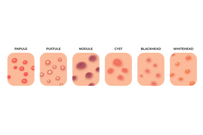 Acne types. Facial infections, pimples and skin inflammation. Skincare