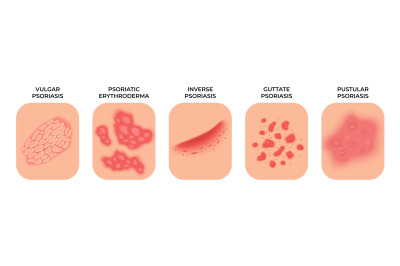 Psoriasis. Allergic eczema types, rashes treatment. Dermatology infect