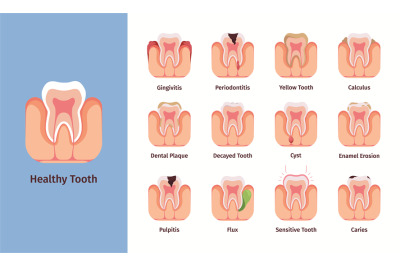 Teeth problems. Medical infographic illustrations with bad commons den