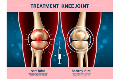 Realistic knee joints. Osteoarthritis treatment&2C; anti inflammatory inj