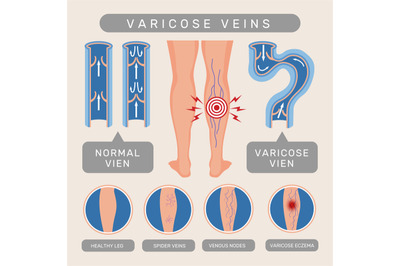 Venous problems. Infographic template of venous disease blood scheme s