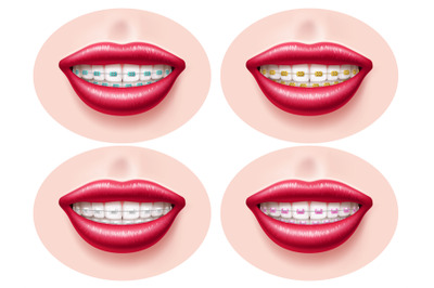 Realistic teeth dental braces. Smiling lips, orthodontic bite correcti