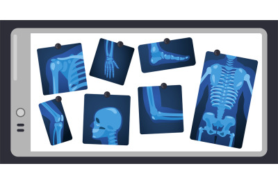 X ray on doctor screen. Human skeleton parts on surgery light pad&2C; bod