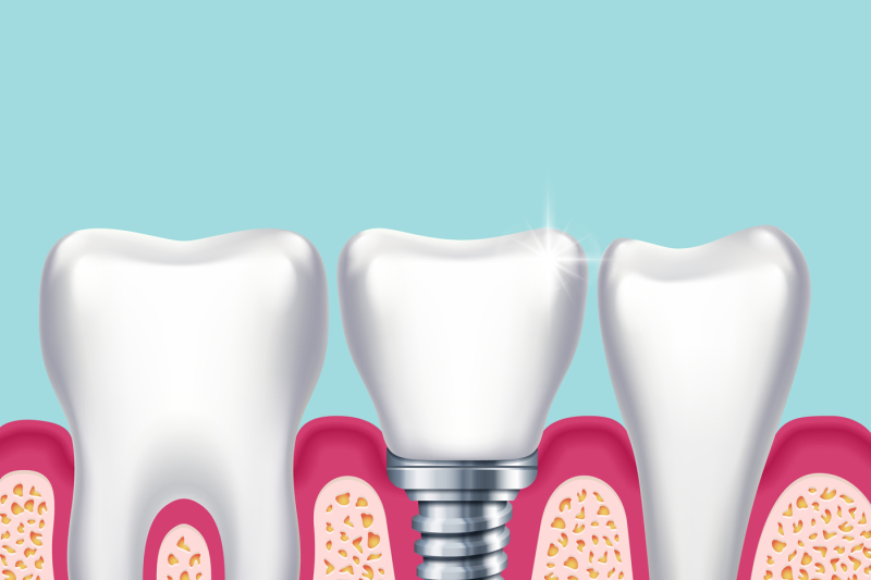 human-teeth-and-dental-implant-in-jaw-orthodontist-medical-vector-illu