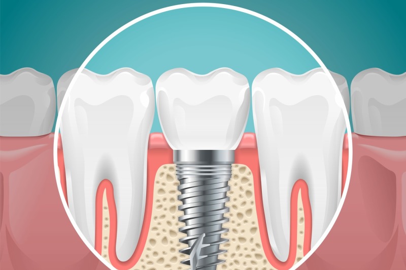 stomatology-illustrations-dental-implants-and-healthy-teeth