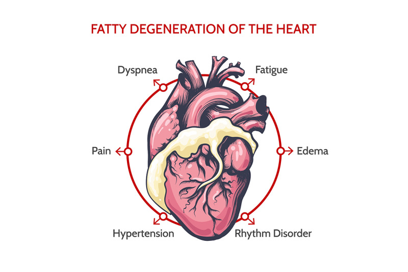 Fatty Degeneration of the Heart. Symptoms of desease illustration. By ...
