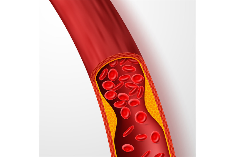 blocked-blood-vessel-artery-with-cholesterol-thrombus-3d-vein-with-c