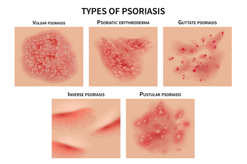 psoriasis-types-skin-hives-derma-diseases-closeup-medical-vector-il