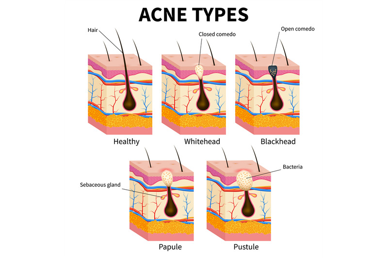 acne-types-pimple-skin-diseases-anatomy-medical-vector-diagram