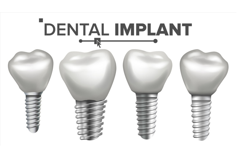 dental-implant-set-vector-implant-structure-crown-abutment-screw-care-stomatology-realistic-isolated-illustration