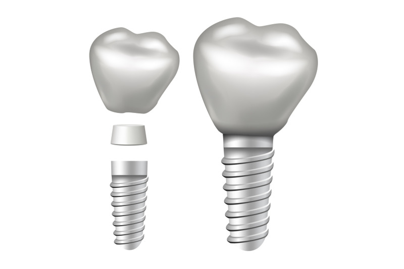dental-implant-vector-implant-structure-crown-abutment-screw-realistic-isolated-illustration
