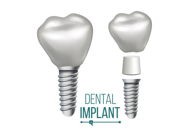 dental-implant-vector-medical-poster-banner-design-element-stomatology-dentist-advertisement-realistic-isolated-illustration