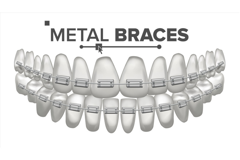 metal-braces-vector-human-jaw-braces-on-teeth-smile-with-braces-3d-realistic-isolated-illustration