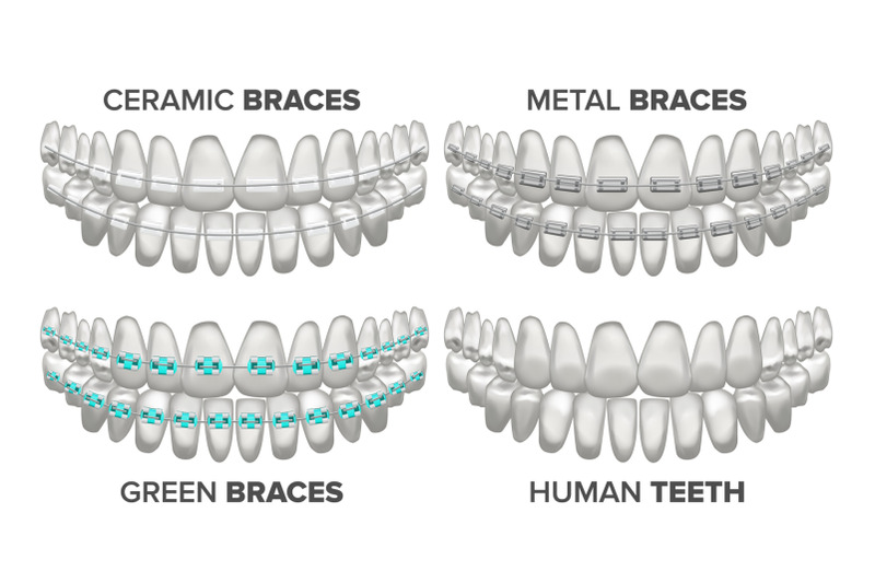 braces-set-vector-different-types-human-jaw-metal-ceramic-child-3d-realistic-isolated-illustration