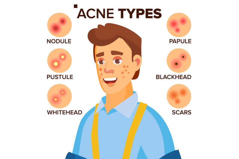 acne-types-vector-man-with-acne-facial-skin-problems-papule-pustulem-scards-isolated-flat-cartoon-character-illustration