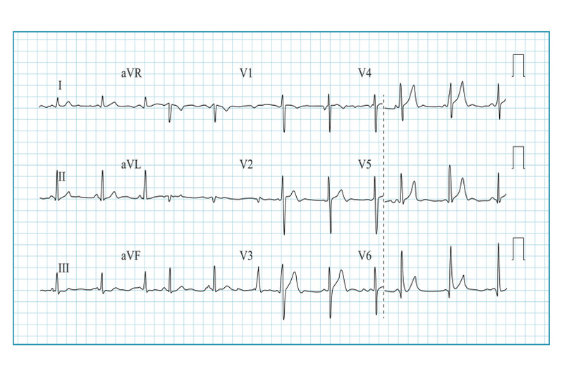 heart-cardiogram-chart-vector-illustration-of-wave-form-on-checked-ecg-graph-heart-rhythm-ischemia-infarction-vitality-heartbeat