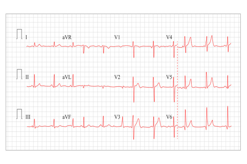 heart-cardiogram-chart-vector