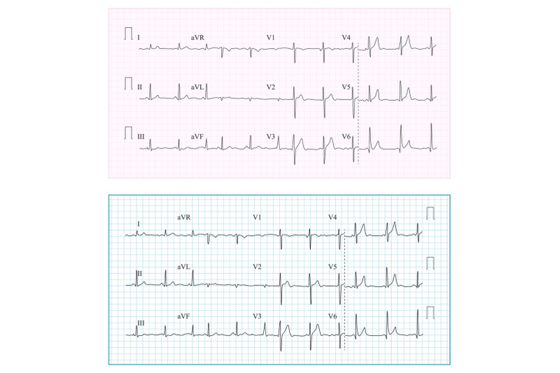 heart-cardiogram-chart-vector-set-healthy-heart-rhythm-ischemia-infarction-vitality-heartbeat-heart-electrocardiogram-pulse-line