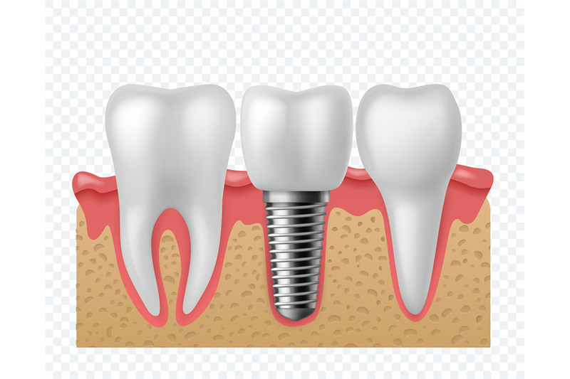 tooth-implant-human-teeth-and-dental-implant-denture-orthodontic-tec