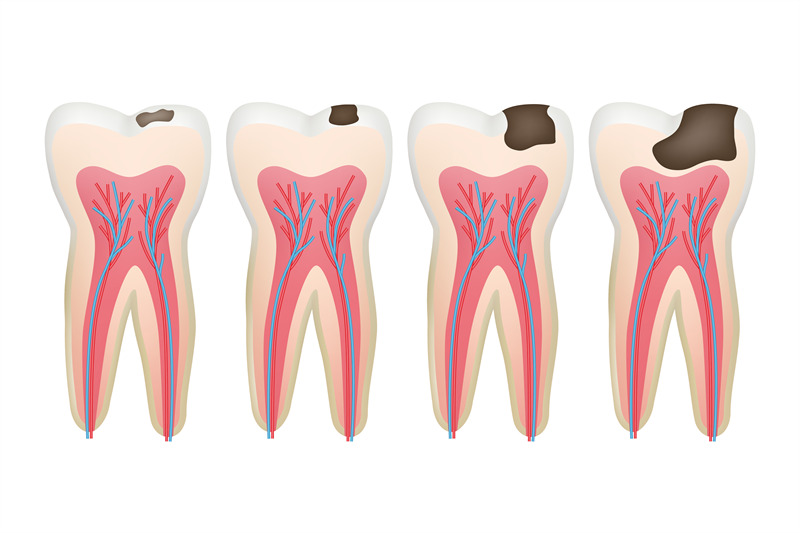 caries-tooth-decay-pulpit-dental-problem-procedure-root-vector-tooth