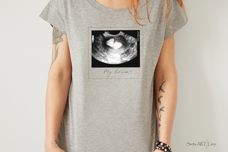 sublimation-png-ultrasound-photos