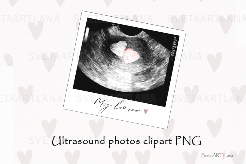 sublimation-png-ultrasound-photos