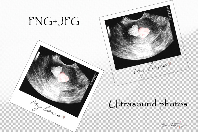 sublimation-png-ultrasound-photos