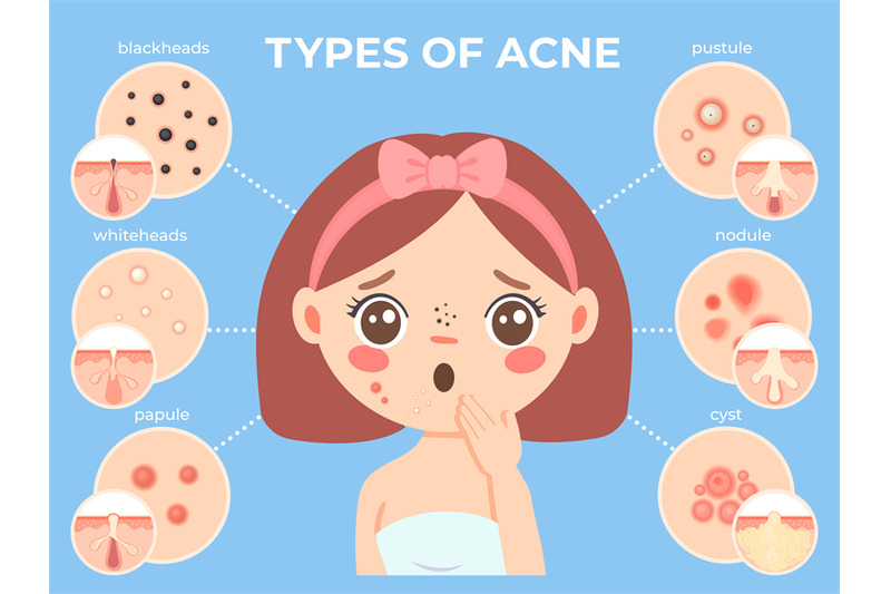 girl-with-acne-young-unhappy-female-face-with-skin-problems-and-pimpl