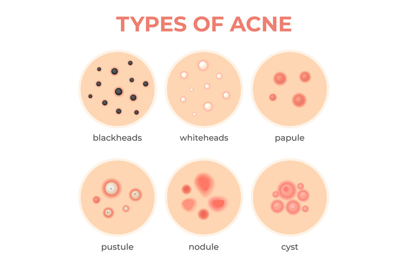 acne-types-skin-infection-problem-pimples-grade-and-type-cyst-white