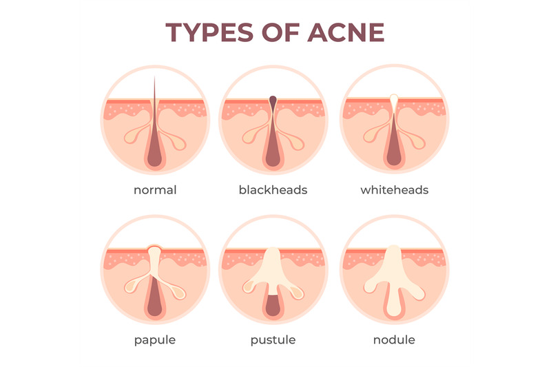 acne-types-anatomy-pimple-diseases-sectional-view-blackhead-cystic-a