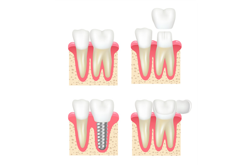 dental-crown-tooth-veneer-implants-healthy-cavity-stomatology-dentist