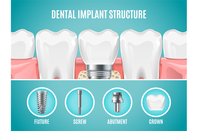 dental-implant-structure-vector-reallistic-tooth-implant-cut-dental