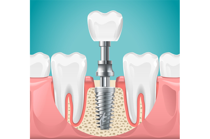 dental-surgery-tooth-implant-cut-vector-illustration-healthy-teeth-a