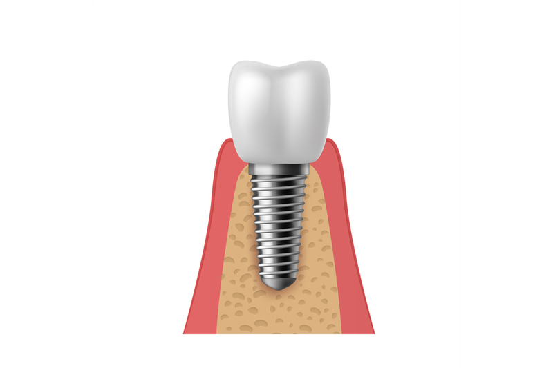 realistic-tooth-implant-3d-denture-orthodontic-implantation-teeth-im