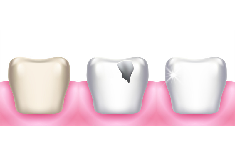 teeth-problems-tooth-decay-dental-diseases-infection-caries-and-ena