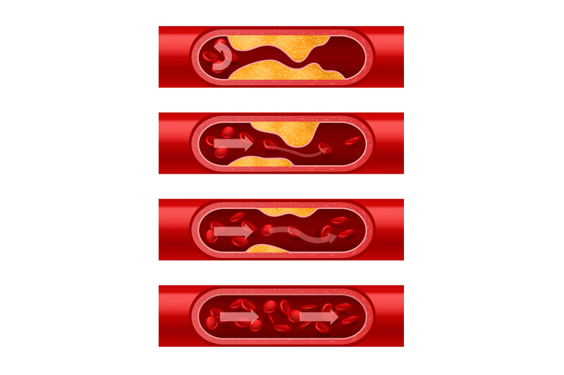 atherosclerosis-artery-step-by-step-cholesterol-deposition-arterial-w