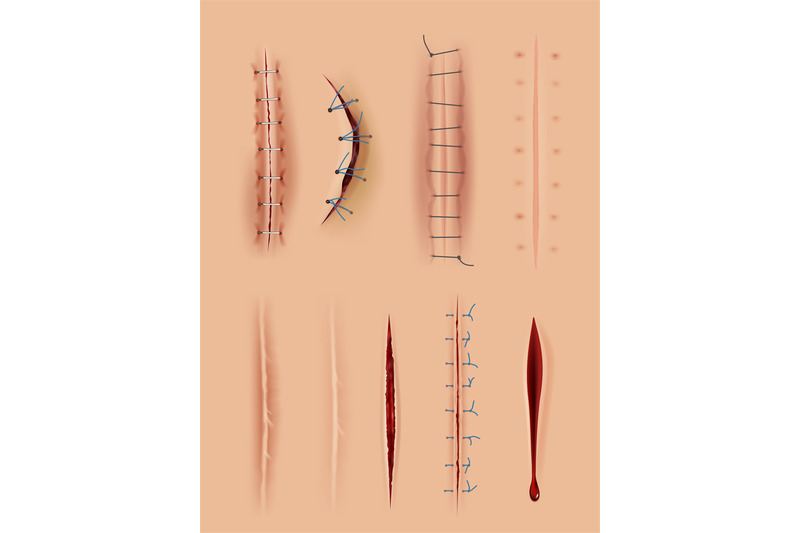 realistic-scars-medical-surgical-sutures-wounds-close-up-pictures-on