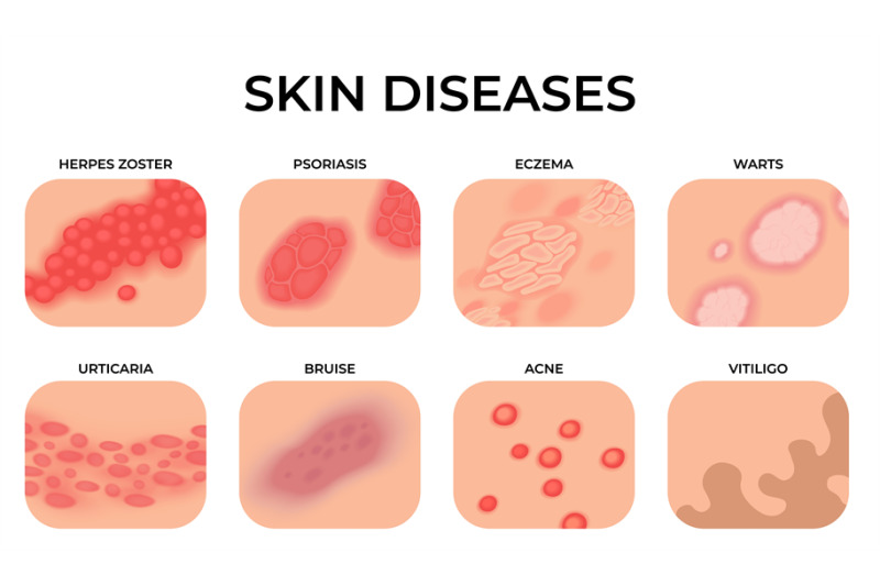 skin-disease-different-diseases-epidermis-surface-with-eczema-derma