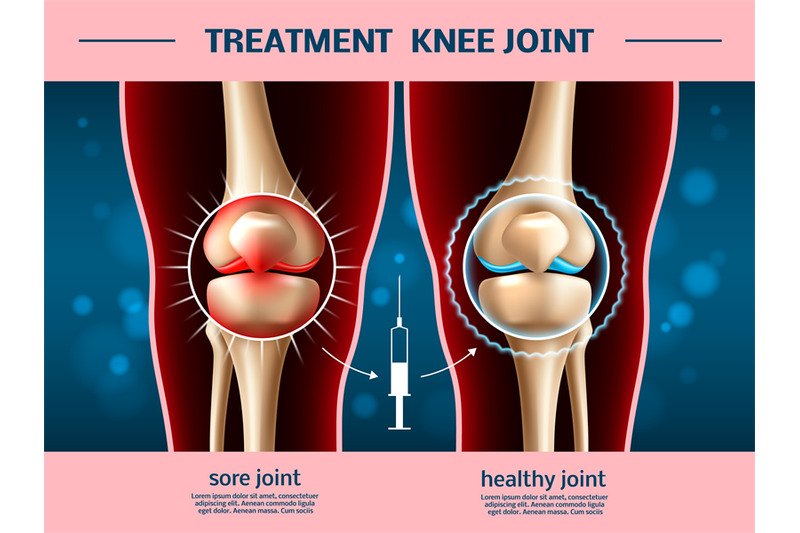 realistic-knee-joints-osteoarthritis-treatment-anti-inflammatory-inj