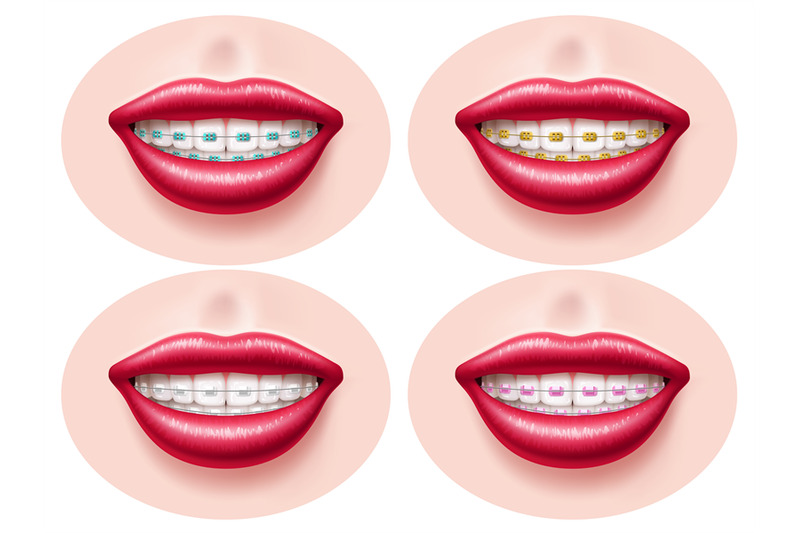 realistic-teeth-dental-braces-smiling-lips-orthodontic-bite-correcti