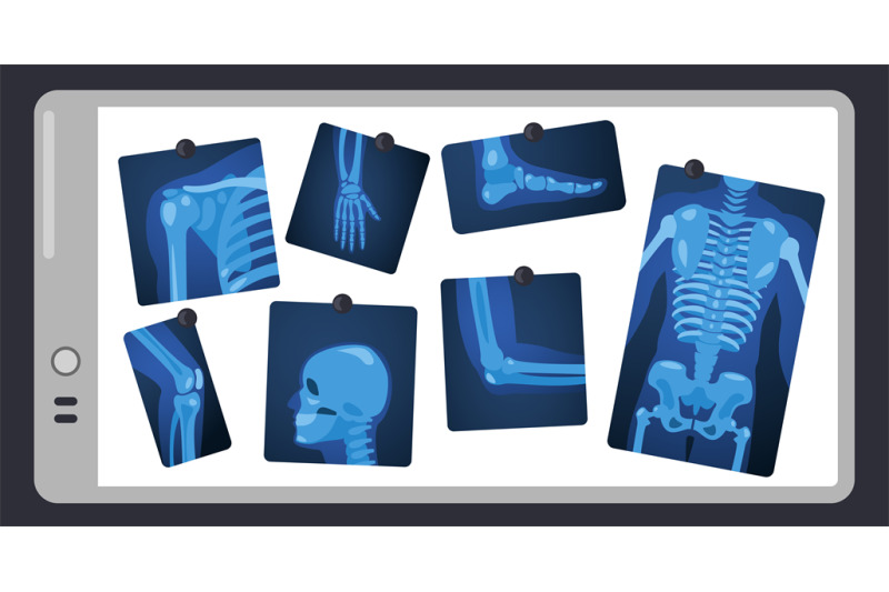 x-ray-on-doctor-screen-human-skeleton-parts-on-surgery-light-pad-bod