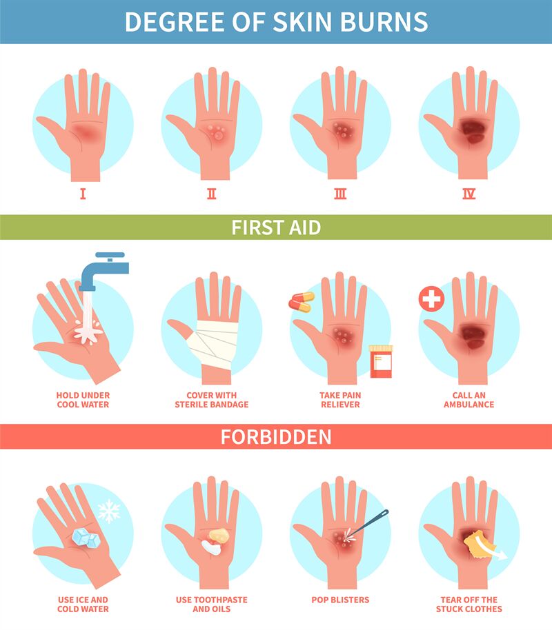 Burns degree. Thermal wound first aid, skin scalds and blisters emerge ...